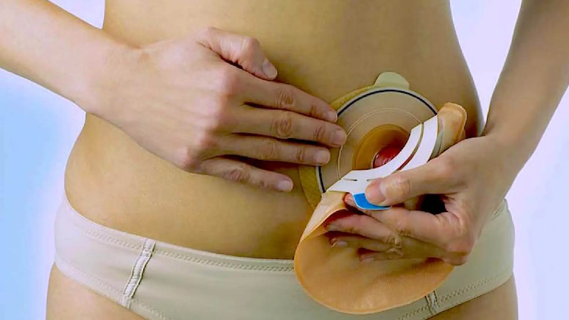 Mujer colocando una bolsa de ostomía de dos piezas sobre la placa adherida al abdomen