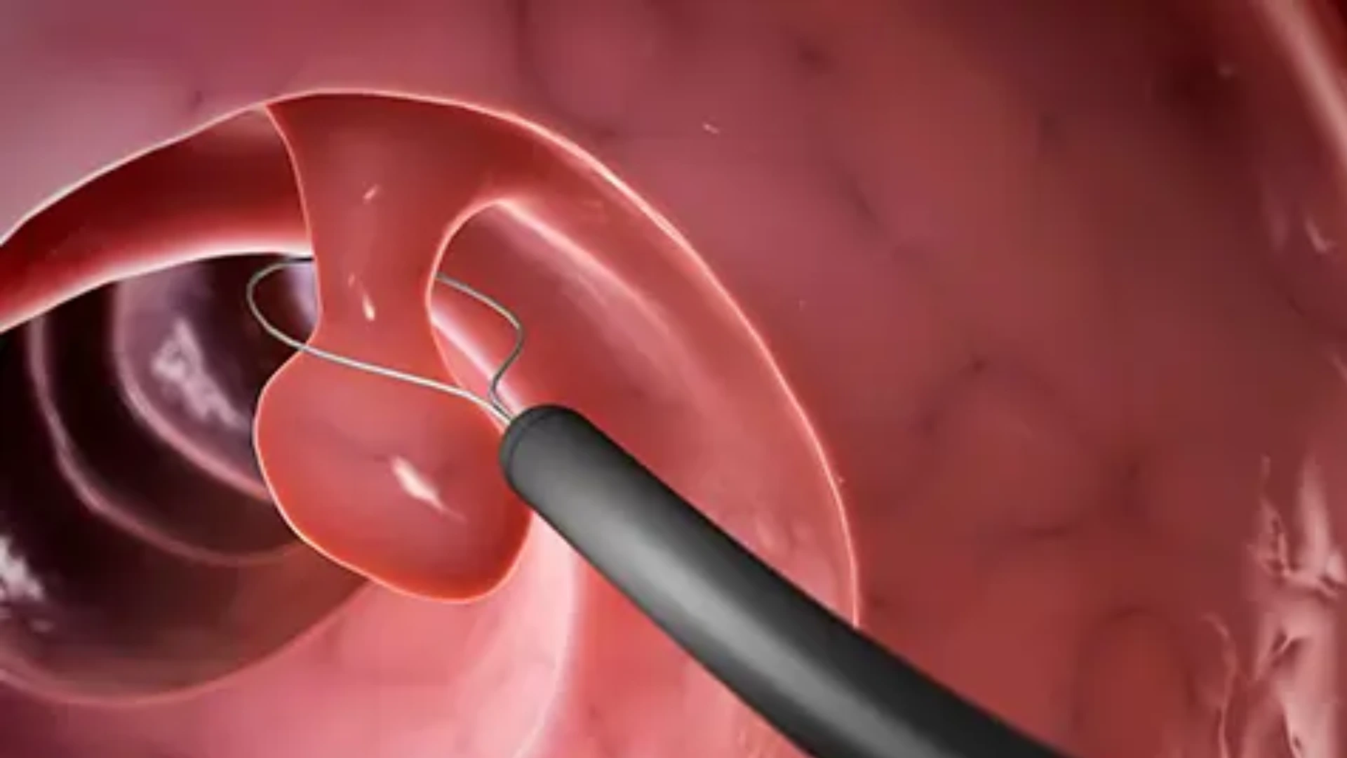 Recreación de una polipectomía: el asa de la colonoscopia rodea la base de un pólipo del colon