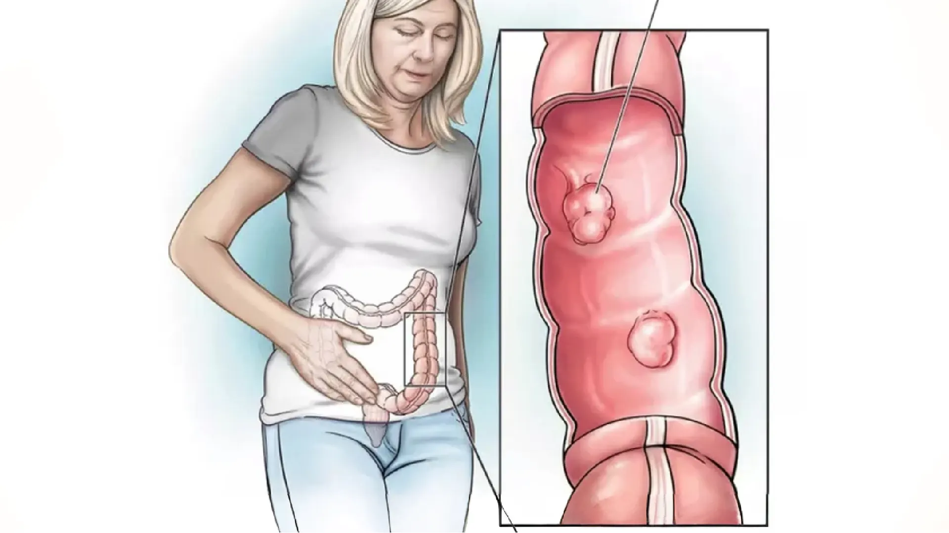 Ilustración de una mujer con la mano en el abdomen y el colon dibujado, con un detalle ampliado de un tramo del colon con dos pólipos