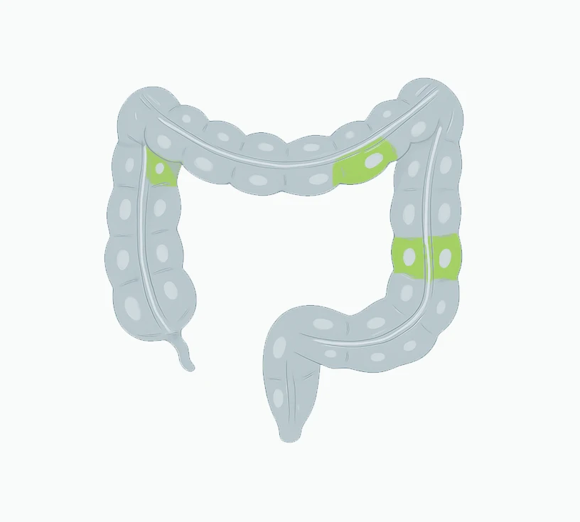 What We Know About Colorectal Cancer Today