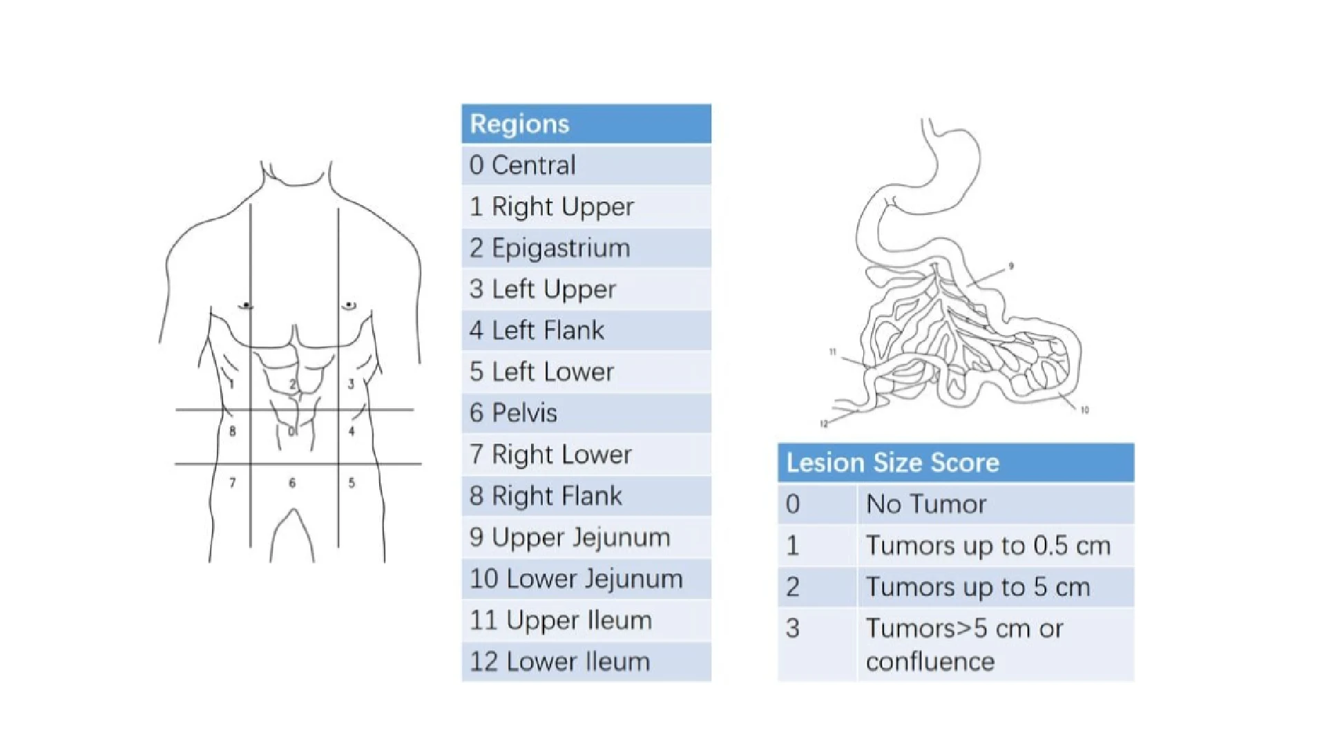 Índice de Carcinomatosis Peritoneal (PCI): qué es y cómo se utiliza