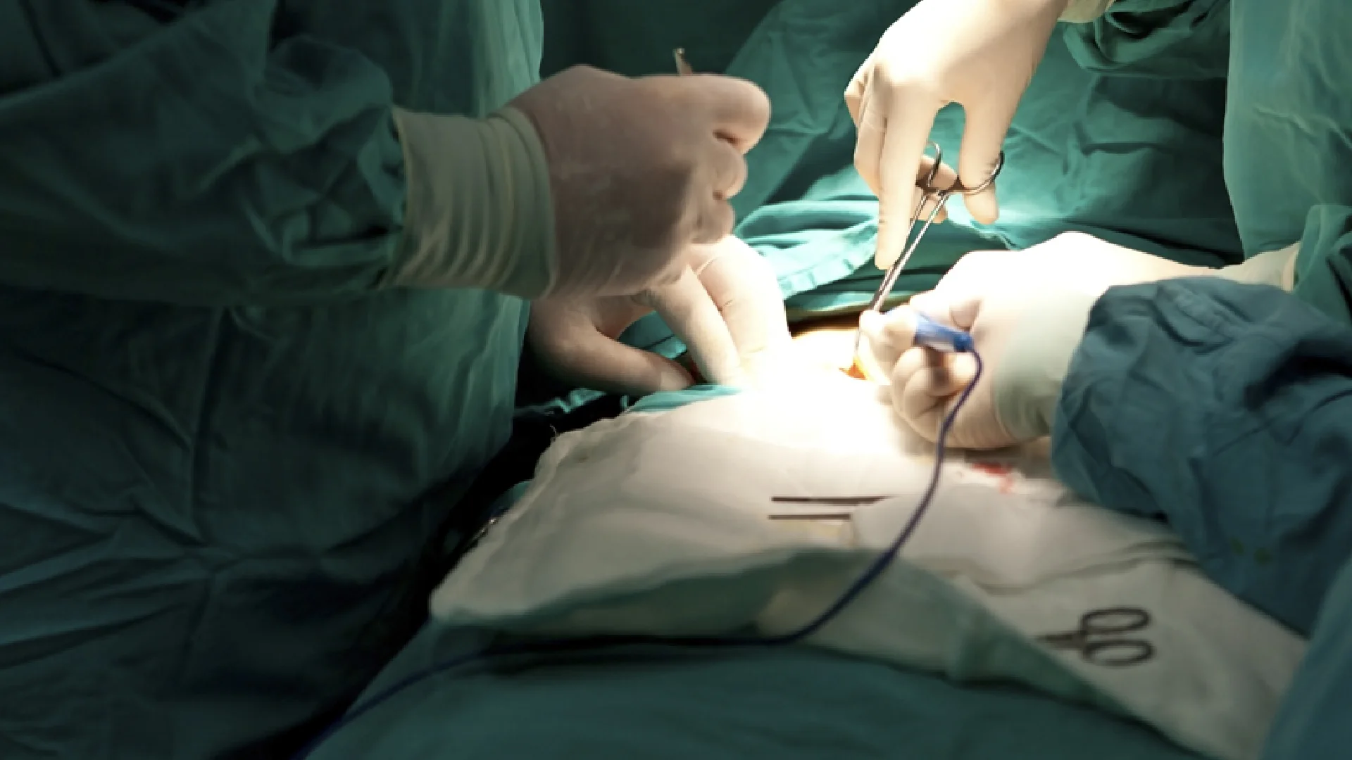 Quimioterapia intraarterial hepática (HAI) en metástasis hepáticas de cáncer colorrectal · Quenet Torrent Institute