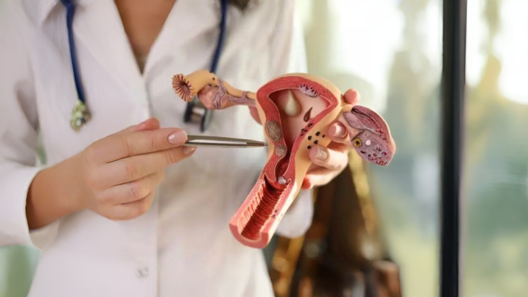 Life expectancy in ovarian cancer: why early diagnosis changes everything