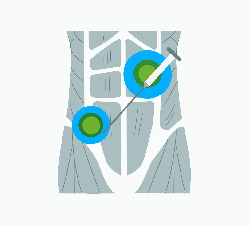 Técnicas con radiología intervencionista