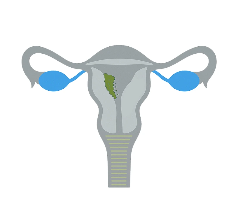 Cáncer-de-endometrio
